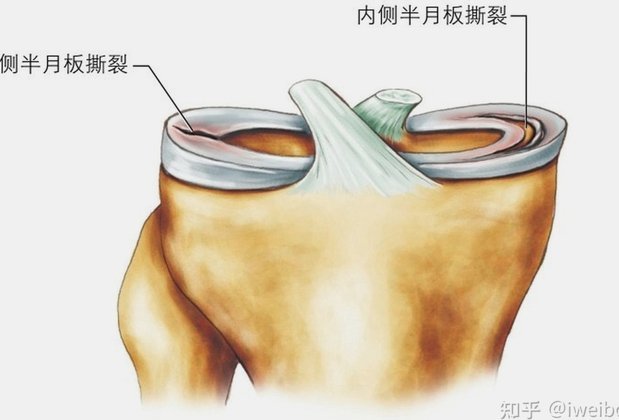 高迪伤情公布：左膝半月板撕裂，4周恢复期